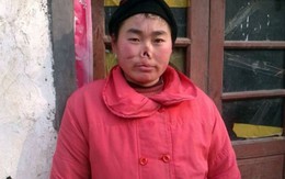 Cô gái bị chuột cắn đứt... mũi
