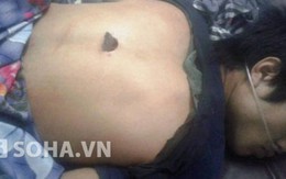Bị đâm ngập lưỡi dao vẫn được cứu sống