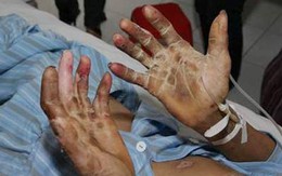 Chết vì “ăn sống nuốt tươi”