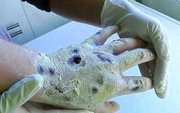 Kinh khủng loại ma túy “ăn thịt người”
