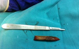 Rút thanh tre dài 5cm sau 9 tháng nằm xuyên não