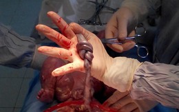 Thai nhi có dây rốn thắt nút 2 vòng vẫn sống sót