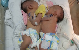 Thêm 2 bé sơ sinh có ngực dính nhau