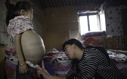 Cuộc sống khốn khổ của bé gái bụng to như bầu 8 tháng