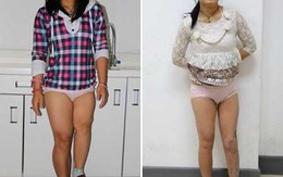 Chân trái ngắn hơn chân phải 23cm do bị vi khuẩn ăn mòn xương