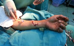 Nối thành công cánh tay bị chém đứt rời
