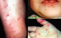 Những căn bệnh nguy hiểm, dễ lây nhất
