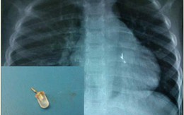 Bé 5 tuổi suy kiệt vì bóng đèn làm ổ trong phế quản