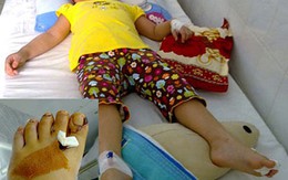 Bé gái bị tấm chắn bô xe máy cắt đứt bàn chân