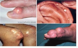 Những món người bị bệnh gout không nên ăn