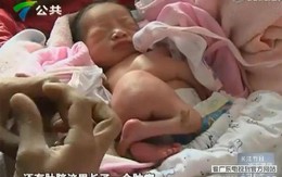 Bé sơ sinh chào đời với cặp chân tay thừa mọc trên bụng