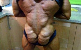 Người đàn ông "biến thành" gà tây do lạm dụng steroid
