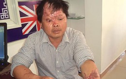 Đòn độc: Vợ thuê người tạt axít biến chồng thành tàn phế?
