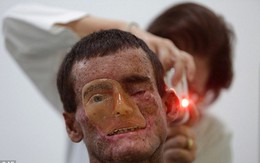 Căn bệnh lạ có thể khiến người dân "tan chảy" dưới ánh nắng mặt trời