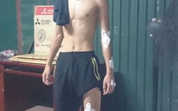 Xe chở axit gây bỏng hàng loạt người đi đường