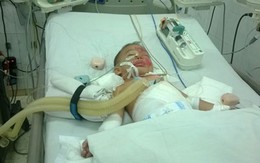 Hai trẻ đuối nước bị bỏ vào lu rồi hơ trên lửa