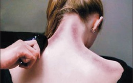 Những trường hợp không được cạo gió vì có thể gây chết người