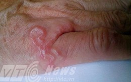 Kinh hãi giun xâm nhập cơ thể, sống lúc nhúc dưới da