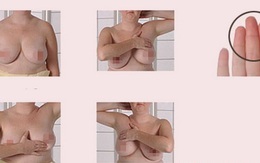 Tự khám vú để phát hiện ung thư ngực sớm nhất