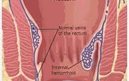 Nghi ngờ bị bệnh trĩ nên khám ở đâu? 