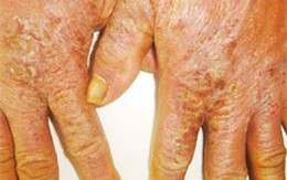 Tư vấn chữa bệnh chàm