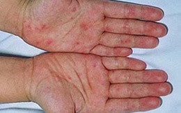 Hỏi - đáp về bệnh chàm khô (á sừng)
