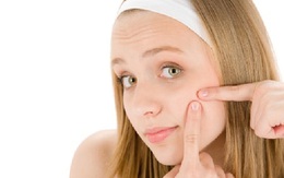 Tư vấn điều trị mụn ở tuổi dậy thì