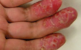 Da tay bi tróc bệnh gì?