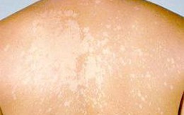 Hỏi - đáp về trị dứt điểm lang ben
