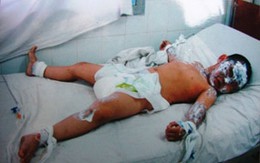 Các nạn nhân gia đình bị tạt axit nguy kịch