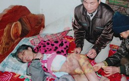 Dấu ấn tàn độc trên người bà giúp việc tố bị chủ hại