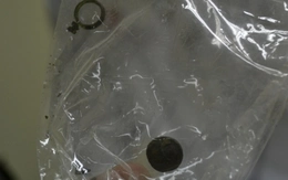 Viên pin “sống” trong mũi em bé 10 tuổi hơn 5 năm nay