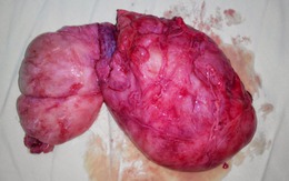 Mổ lấy khối u lớn trước xương cùng cụt