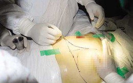 Phẫu thuật thẩm mỹ nâng ngực: Phương pháp hút mỡ đã bị bỏ từ lâu