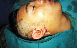 Nối thành công tai đứt rời do bị cắt