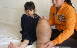 Xót xa bé 8 tuổi mang khối u khổng lồ ở chân