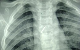Bé trai 6 tuổi nuốt phải đinh ghim