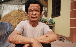Người có nghìn cục thịt trên cơ thể