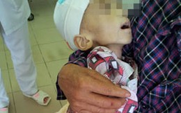 Bé 3 tuổi tử vong vì mẹ tự điều trị bỏng 