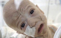 Bi kịch của cậu bé thiếu ruột