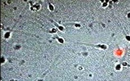 Tinh trùng - thủ phạm khiến đàn ông hiếm muộn