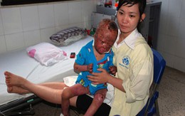 Bé 3 tuổi bị bố đẻ tưới xăng đốt giờ ra sao?