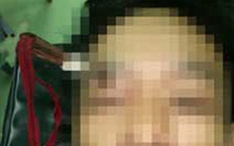Hy hữu: Tự đâm kéo vào mắt, mắt vẫn bình thường