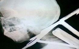 Một chiến sĩ cảnh sát bị đâm bồ cào xuyên đầu