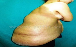 Cô gái 24 tuổi mang khối u 7kg sau lưng