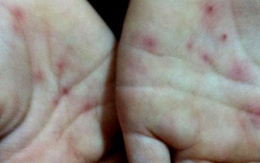 Không thể kết luận cô giáo đâm kim vào tay bé mầm non