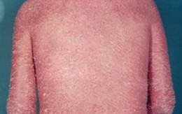 Vẩy nến thể đỏ da toàn thân – Khó khăn trong việc điều trị