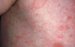 Điều trị bệnh vẩy da- Đừng quên các kem dược liệu bôi ngoài