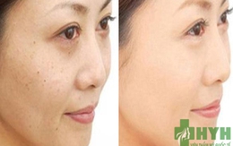 Nám da – Không còn là ám ảnh của phụ nữ