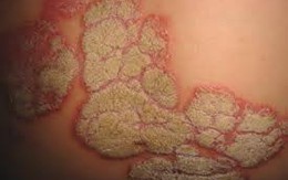 Vẩy nến – hủy hoại làn da người bệnh